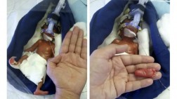 Bobot Bertambah, Bayi Terkecil di Dunia Tinggalkan RS Tokyo